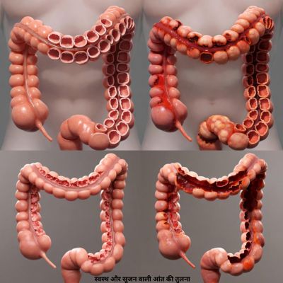 स्वस्थ और सूजन वाली आंत की तुलना